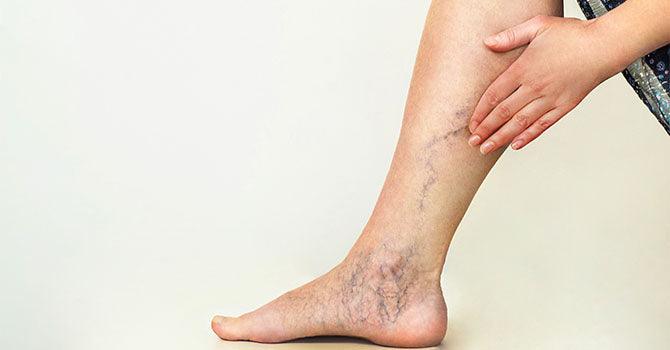 Sclerotherapy